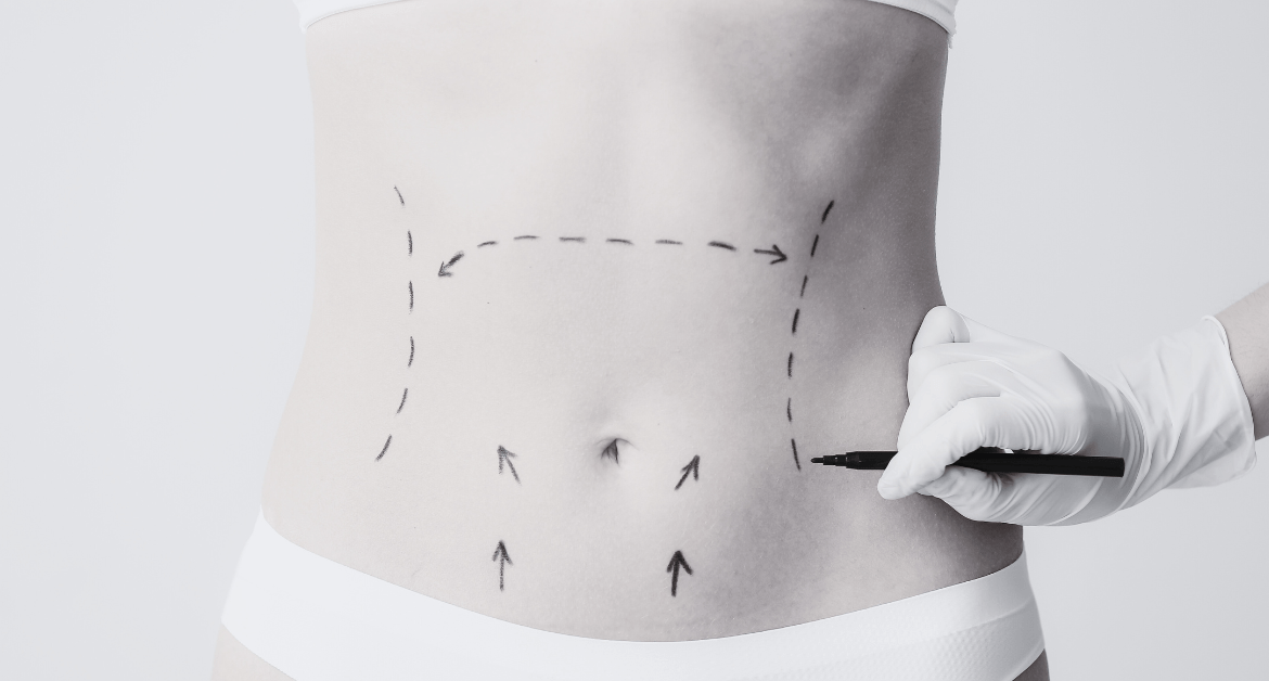 Lipödem: symtom, diagnos och behandling